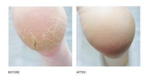 Footlogix cracked heel formula 2025